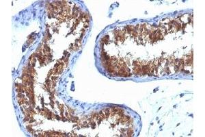 Formalin-fixed, paraffin-embedded human testicular carcinoma stained with Major Vault Protein antibody (1032). (MVP antibody)