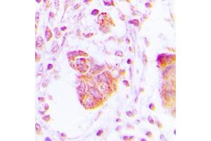 Immunohistochemical analysis of MOV10L1 staining in human lung cancer formalin fixed paraffin embedded tissue section. (MOV10L1 antibody  (Center))
