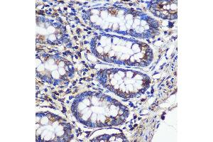 Immunohistochemistry of paraffin-embedded Human colon using SND1 Rabbit pAb (ABIN6129741, ABIN6148197, ABIN6148199 and ABIN6221577) at dilution of 1:100 (40x lens).