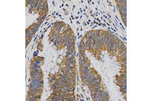 Immunohistochemistry of paraffin-embedded human rectal cancer tissue using PIBF1 antibody at dilution of 1:200 (x400 lens). (PIBF1 antibody)
