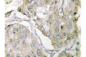 Immunohistochemical analysis of paraffin-embedded human breast cancer tissue using TMPRSS3 polyclonal antibody . (TMPRSS3 antibody)