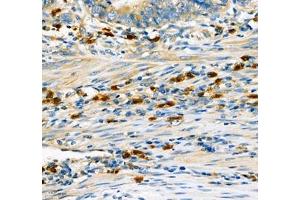 Immunohistochemistry of paraffin embedded human gastric cancer using CD307 (ABIN7073931) at dilution of 1:600 (300x lens) (FCRL5 antibody)