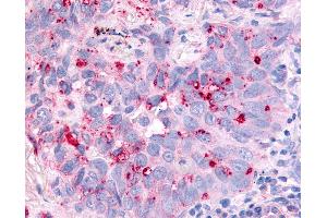 Anti-CDC7 antibody IHC of human Lung, Non-Small Cell Carcinoma. (CDC7 antibody  (Kinase Domain))