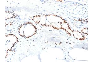 Formalin-fixed, paraffin-embedded human Breast Carcinoma stained with Estrogen Receptor alpha Mouse Monoclonal Antibody (ESR1/1904).