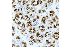 Immunohistochemical analysis of BPGM staining in human gastric cancer formalin fixed paraffin embedded tissue section. (BPGM antibody)