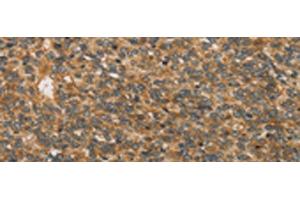 Immunohistochemistry of paraffin-embedded Human ovarian cancer tissue using XPR1 Polyclonal Antibody at dilution of 1:45(x200) (xpr1 antibody)