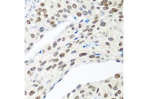 Immunohistochemistry of paraffin-embedded human prostate cancer using MDC1 antibody. (MDC1 antibody)