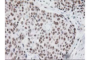 Immunohistochemical staining of paraffin-embedded Adenocarcinoma of Human breast tissue using anti-MGLL mouse monoclonal antibody. (MGLL antibody)