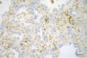 Immunohistochemistry was performed on paraffin-embedded human lung adenocarcinoma using beta actin antibody (ABIN7797467), 1:200).