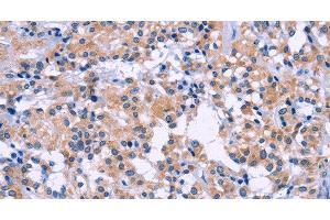 Immunohistochemistry of paraffin-embedded Human thyroid cancer tissue using DUSP22 Polyclonal Antibody at dilution 1:60 (DUSP22 antibody)