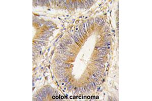 Formalin-fixed and paraffin-embedded human colon carcinomareacted with AKR1B1 polyclonal antibody , which was peroxidase-conjugated to the secondary antibody, followed by AEC staining. (AKR1B1 antibody  (Internal Region))