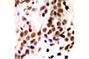 Immunohistochemical analysis of GTF2IRD1 staining in human breast cancer formalin fixed paraffin embedded tissue section. (GTF2IRD1 antibody  (N-Term))