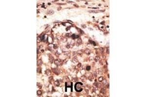 Formalin-fixed and paraffin-embedded human cancer tissue reacted with the primary antibody, which was peroxidase-conjugated to the secondary antibody, followed by AEC staining. (MMP8 antibody  (AA 286-315))