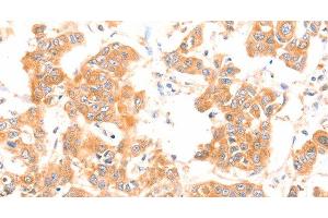 Immunohistochemistry of paraffin-embedded Human breast cancer using PRDX2 Polyclonal Antibody at dilution of 1:80 (Peroxiredoxin 2 antibody)