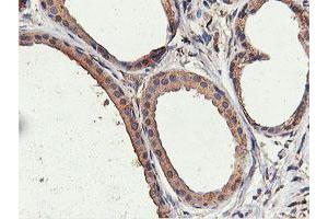 Immunohistochemical staining of paraffin-embedded Human breast tissue using anti-ILVBL mouse monoclonal antibody. (ILVBL antibody)