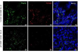 Representative confocal micrographs of healthy prostate tissue and prostate adenorcarcinoma (Gleason 5) microarrays (Biomax Inc. (RAP1A antibody  (Center))