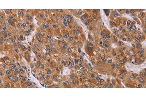Immunohistochemistry of paraffin-embedded Human liver cancer tissue using CALCA Polyclonal Antibody at dilution 1:40 (CGRP antibody)
