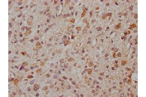 IHC image of ABIN7166521 diluted at 1:300 and staining in paraffin-embedded human glioma cancer performed on a Leica BondTM system. (PCDHa8 antibody  (AA 719-922))