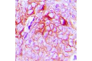 Immunohistochemical analysis of GPR34 staining in human breast cancer formalin fixed paraffin embedded tissue section. (GPR34 antibody  (Center))