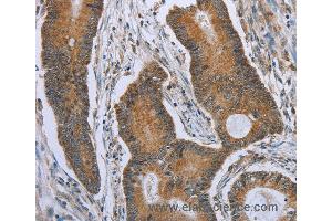 Immunohistochemistry of Human colon cancer using TNFRSF13C Polyclonal Antibody at dilution of 1:40