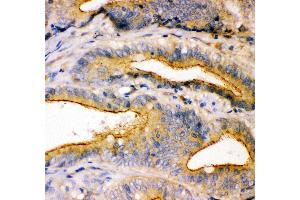 Anti- TJP1 antibody, IHC(P) IHC(P): Human Intestinal Cancer Tissue (TJP1 antibody  (AA 1178-1527))