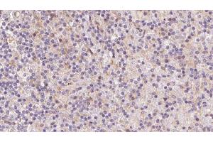 ABIN6273082 at 1/100 staining Human lymph cancer tissue by IHC-P. (Tropomodulin 4 antibody  (Internal Region))