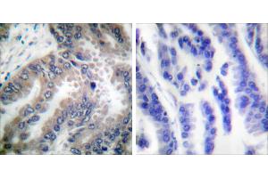 Peptide - +Immunohistochemical analysis of paraffin-embedded human lung carcinoma tissue using Caspase 8 (Ab-347) antibody (#B0059). (Caspase 8 antibody  (Ser347))