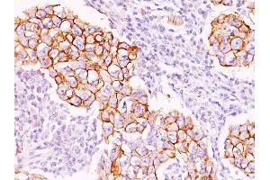 Formalin-fixed, paraffin-embedded human Breast Carcinoma stained with Phosphotyrosine Mouse Monoclonal Antibody (PY20). (Phosphotyrosine antibody)