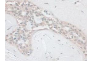 IHC-P analysis of Human Breast Cancer Tissue, with DAB staining. (PCSK1 antibody  (AA 500-738))