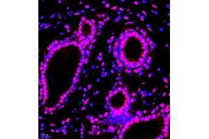Immunofluorescence of paraffin embedded human breast cancer using smad62024 (ABIN7075629) at dilution of 1:1000 (400x lens) (SMAD6 antibody)