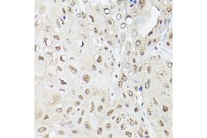 Immunohistochemistry of paraffin-embedded human esophageal cancer using UBQLN2 Rabbit pAb (ABIN6127815, ABIN6149859, ABIN6149860 and ABIN6225041) at dilution of 1:250 (40x lens). (Ubiquilin 2 antibody  (AA 1-150))