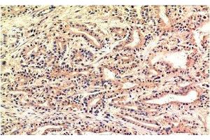 Immunohistochemistry of paraffin-embedded Human stomach carcinoma tissue using CHOP Monoclonal Antibody at dilution of 1:200. (DDIT3 antibody)