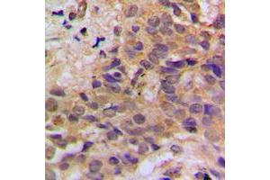 Immunohistochemical analysis of p53 (pS37) staining in human breast cancer formalin fixed paraffin embedded tissue section. (p53 antibody  (N-Term, pSer37))