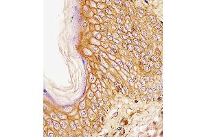 CD44 antibody (ABIN659120 and ABIN2843760) immunohistochemistry analysis in formalin fixed and paraffin embedded human esophagus carcinoma followed by peroxidase conjμgation of the secondary antibody and DAB staining. (CD44 antibody)