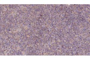 ABIN6273139 at 1/100 staining Human lymph cancer tissue by IHC-P. (MEST antibody  (C-Term))