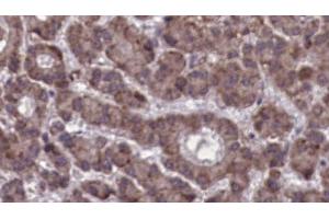 ABIN6273923 at 1/100 staining Human liver cancer tissue by IHC-P. (CCKBR antibody  (N-Term))