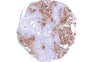 Esophageal squamous cell carcinoma with moderate to strong PAI2 positivity of intermediate and superficial tumor cell layers