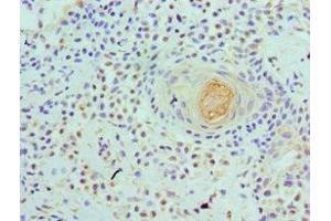 Immunohistochemistry of paraffin-embedded human breast tissue using ABIN7175761 at dilution of 1:100 (WDR5 antibody  (AA 1-334))