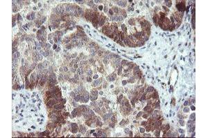 Immunohistochemical staining of paraffin-embedded Adenocarcinoma of Human ovary tissue using anti-TBCC mouse monoclonal antibody. (TBCC antibody)