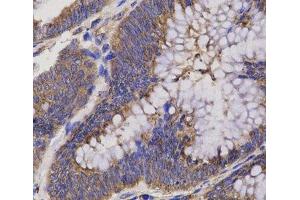 Immunohistochemistry of paraffin-embedded Human rectum cancer using EPHX2 Polyclonal Antibody at dilution of 1:200 (40x lens). (EPHX2 antibody)