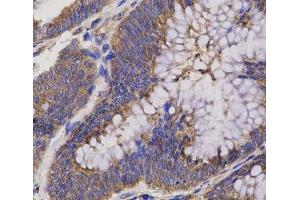 Immunohistochemistry of paraffin-embedded Human rectum cancer using EPHX2 Polyclonal Antibody at dilution of 1:200 (40x lens).