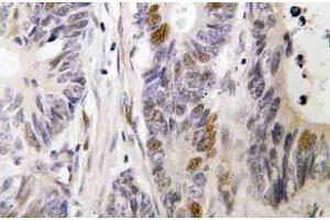 Immunohistochemistry (IHC) analyzes of c-Fos antibody in paraffin-embedded human colon carcinoma tissue. (c-FOS antibody)