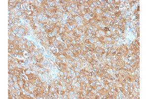 Formalin-fixed, paraffin-embedded human Prostate Carcinoma stained with CD63 Rabbit Recombinant Monoclonal Antibody (LAMP3/2990R). (Recombinant CD63 antibody)