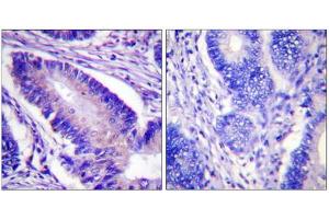 Immunohistochemistry analysis of paraffin-embedded human colon carcinoma tissue using eIF4B (Phospho-Ser422) antibody. (EIF4B antibody  (pSer422))