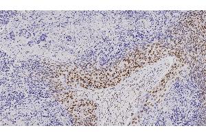 Human squamous cell carcinoma: immunohistochemical staining for mismatch repair protein (MLH1). (MSH2 antibody)