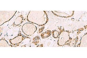 Immunohistochemistry of paraffin-embedded Human thyroid cancer tissue using ISOC2 Polyclonal Antibody at dilution of 1:95(x200) (ISOC2 antibody)