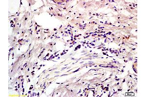 Formalin-fixed and paraffin embedded human colon carcinoma labeled with Anti-CD45RO Polyclonal Antibody, Unconjugated (ABIN733283) at 1:200 followed by conjugation to the secondary antibody and DAB staining (CD45RO antibody)