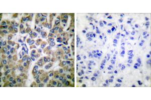 Peptide - +Immunohistochemical analysis of paraffin-embedded human breast carcinoma tissue using HSP10 antibody (#C0230). (HSPE1 antibody)