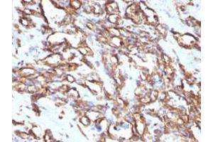 Immunohistochemical staining (Formalin-fixed paraffin-embedded sections) of human angiosarcoma with VIM monoclonal antibody, clone VM1170 . (Vimentin antibody)