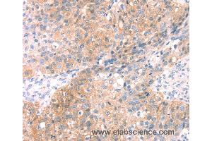 Immunohistochemistry of Human breast cancer using SNAP23 Polyclonal Antibody at dilution of 1:25 (SNAP23 antibody)